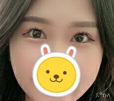When it comes to eyes, Hyundai Aesthetic Surgery really seems right haha