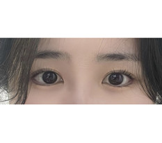 My lateral and inferior canthoplasty review~~~