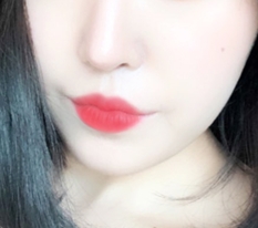 Very very satisfied with mouth-corner surgery!!