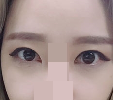 I had double eyelid surgery and dual canthoplasty!