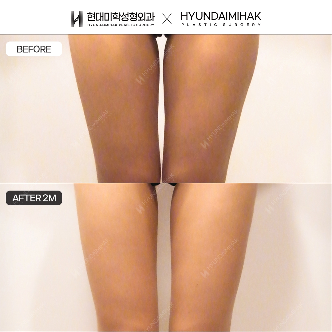 2 months after thigh liposuction