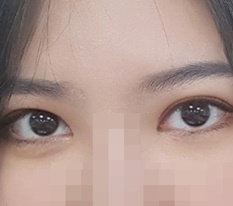 Incisional double eyelid and inner-corner opening review : )