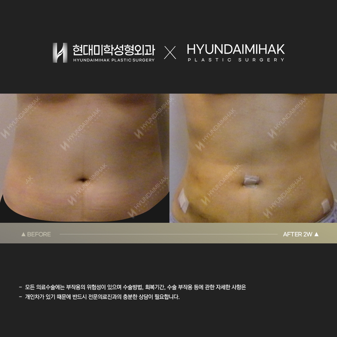 Abdominal Liposuction, Week 2