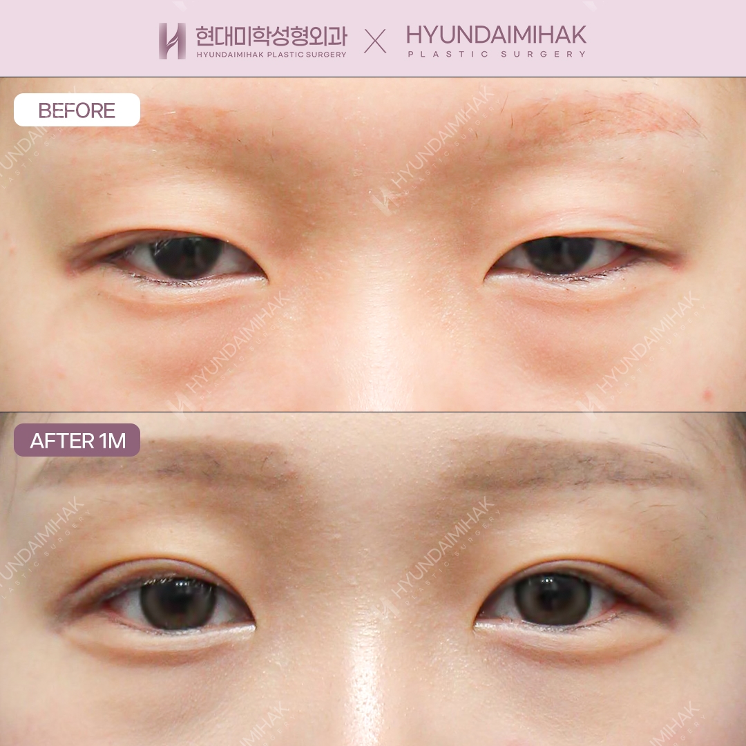 Incisional double eyelid surgery + eye shape correction