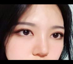 Review of incision double eyelid, inner corner, and nose surgery