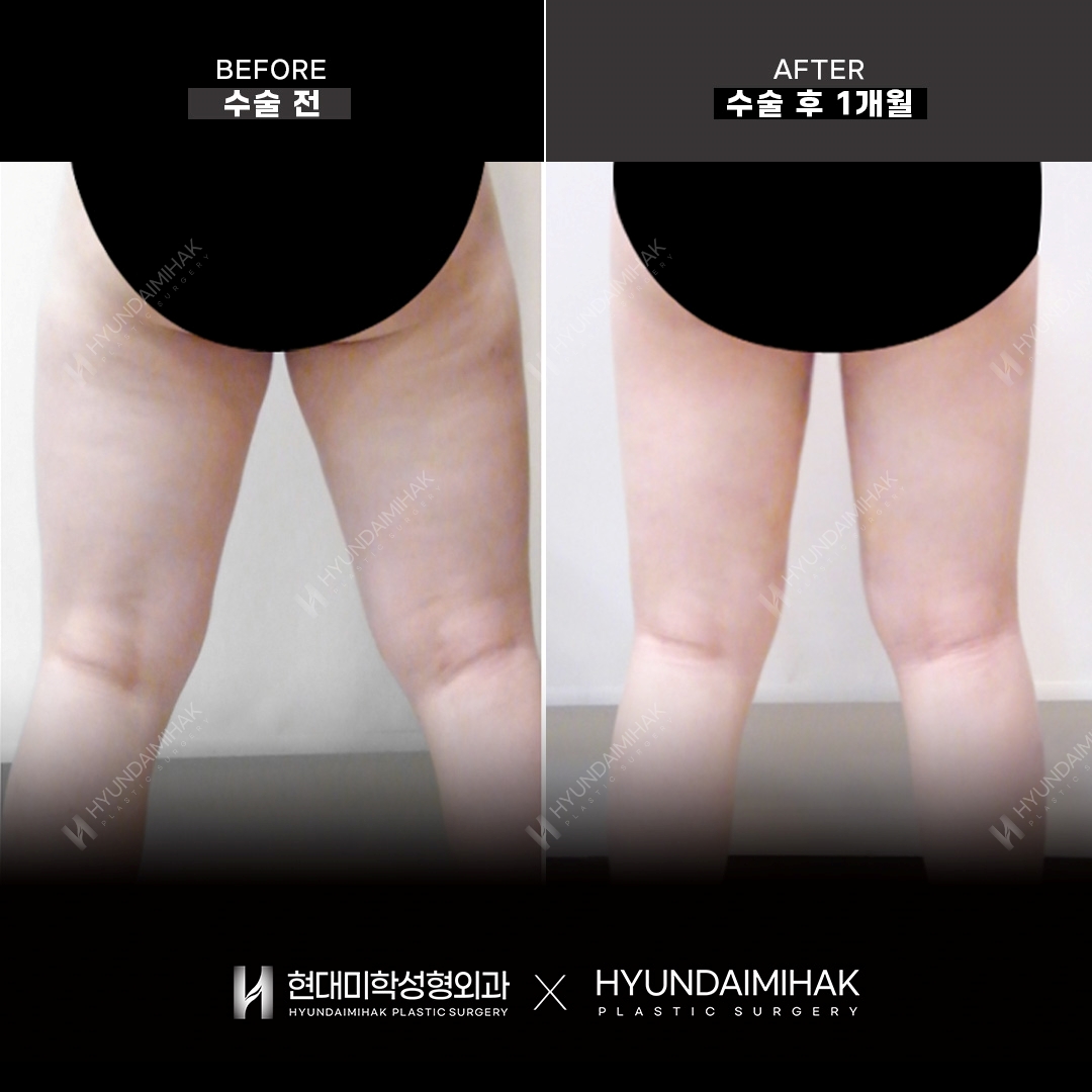 Thigh liposuction, 1 month after surgery