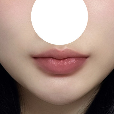 Before and after Cupid line lip surgery for plain lips!