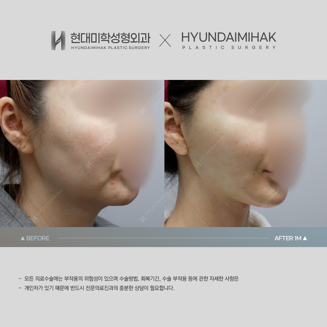 [Anti-aging Surgery] Thread lift, 1 month