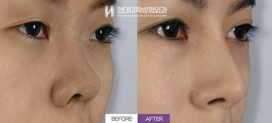 Rhinoplasty + Nasal Tip Surgery, 3 Months