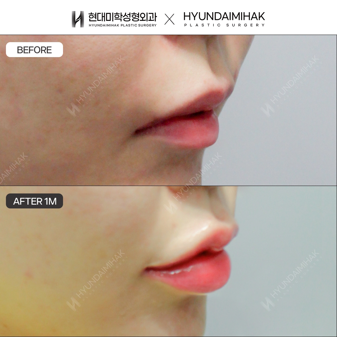 Mouth Corner Surgery and Asymmetry Correction, 1 Month