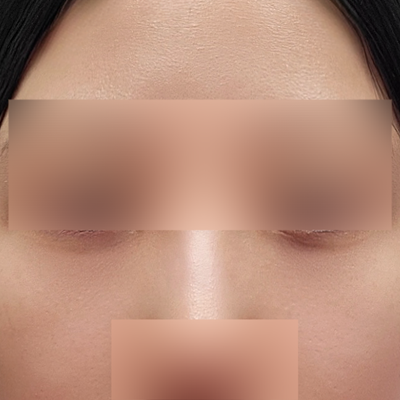 Effect of under-eye fat repositioning