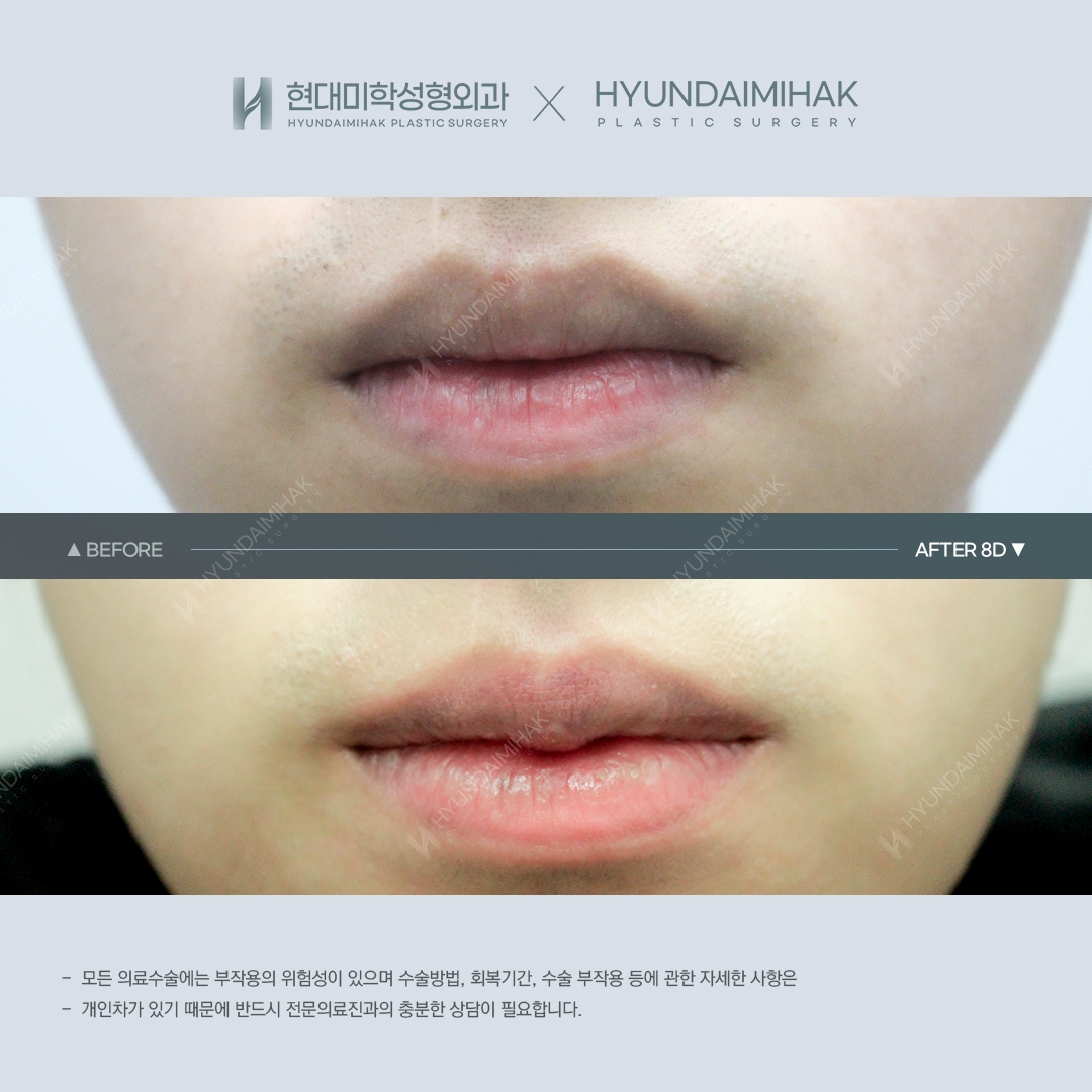 [Lip Surgery] Cupid's Bow Lip Surgery, 8 Days