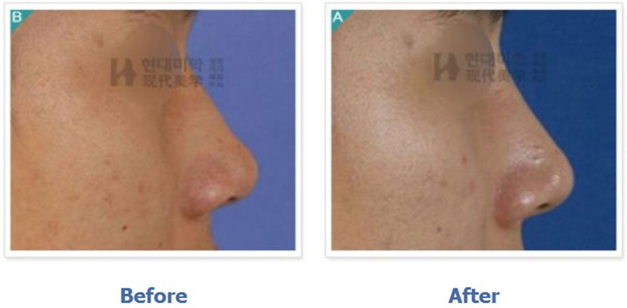 Rhinoplasty