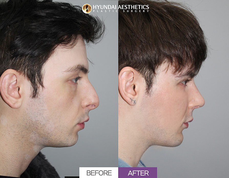 Hump Nose Rhinoplasty + Nasal Tip Surgery