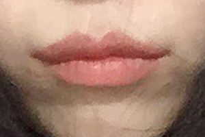 Now I understand why people get corner lip surgery