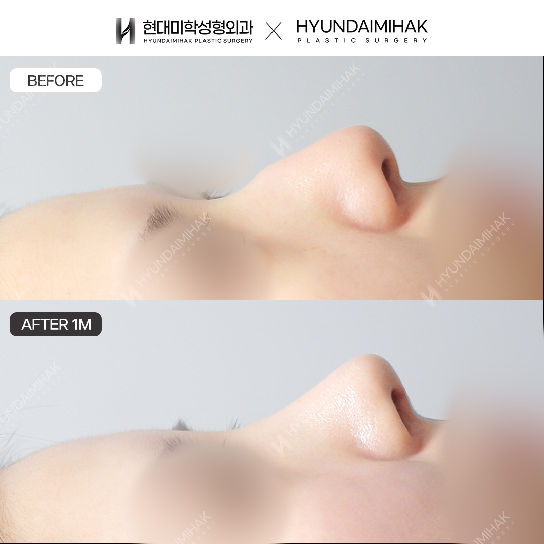 [Hump Nose Surgery] Bridge + Tip, 1 Month
