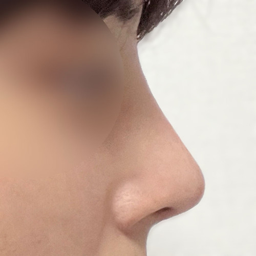 A man's first nose surgery journey