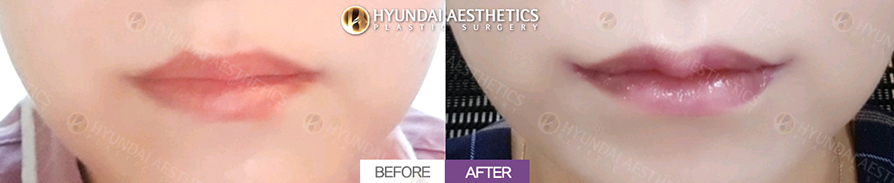 Mouth Corner Lift + Marionette Lines + Cupid's Bow