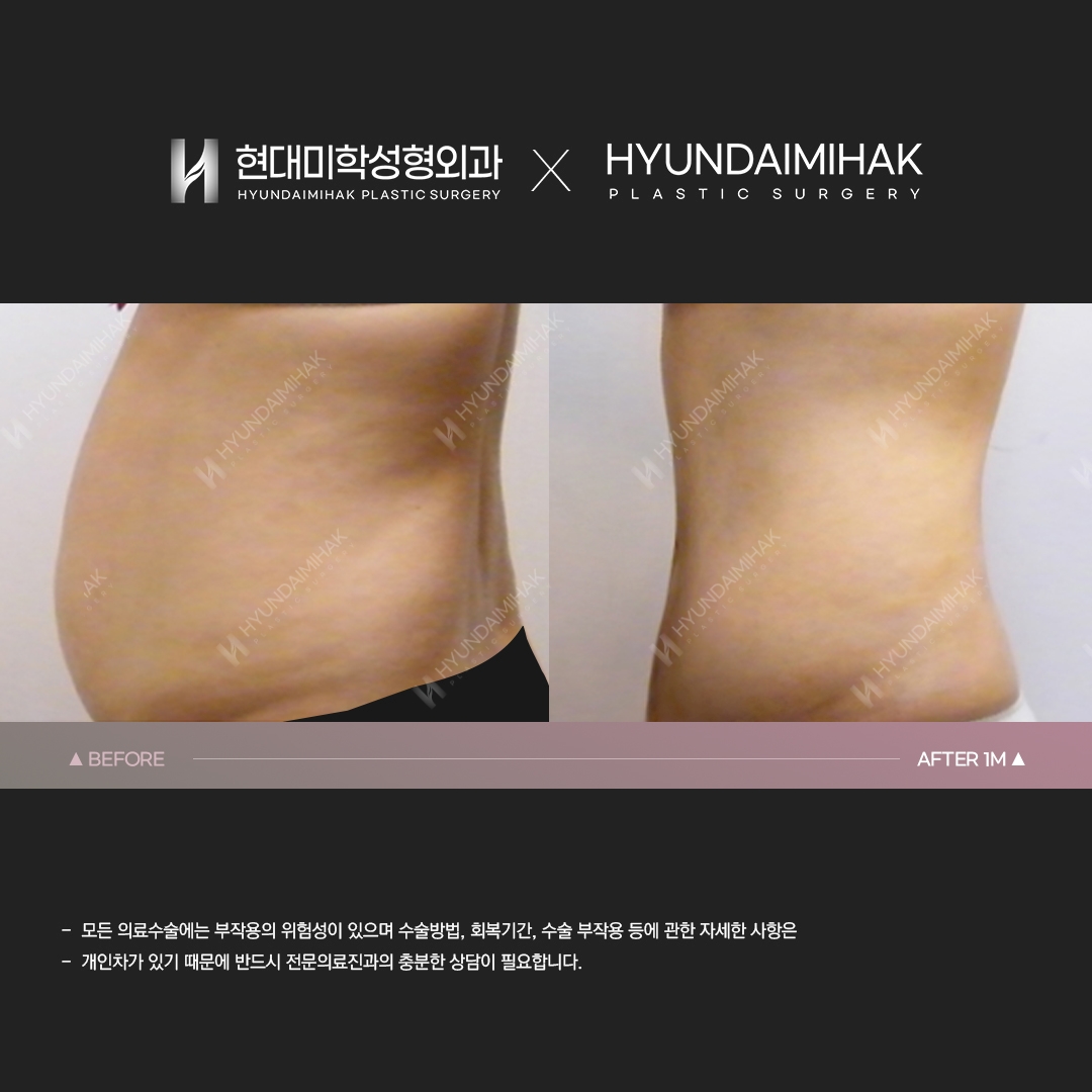 Abdominal liposuction, 1 month post-op