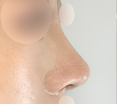 My nose got prettier
