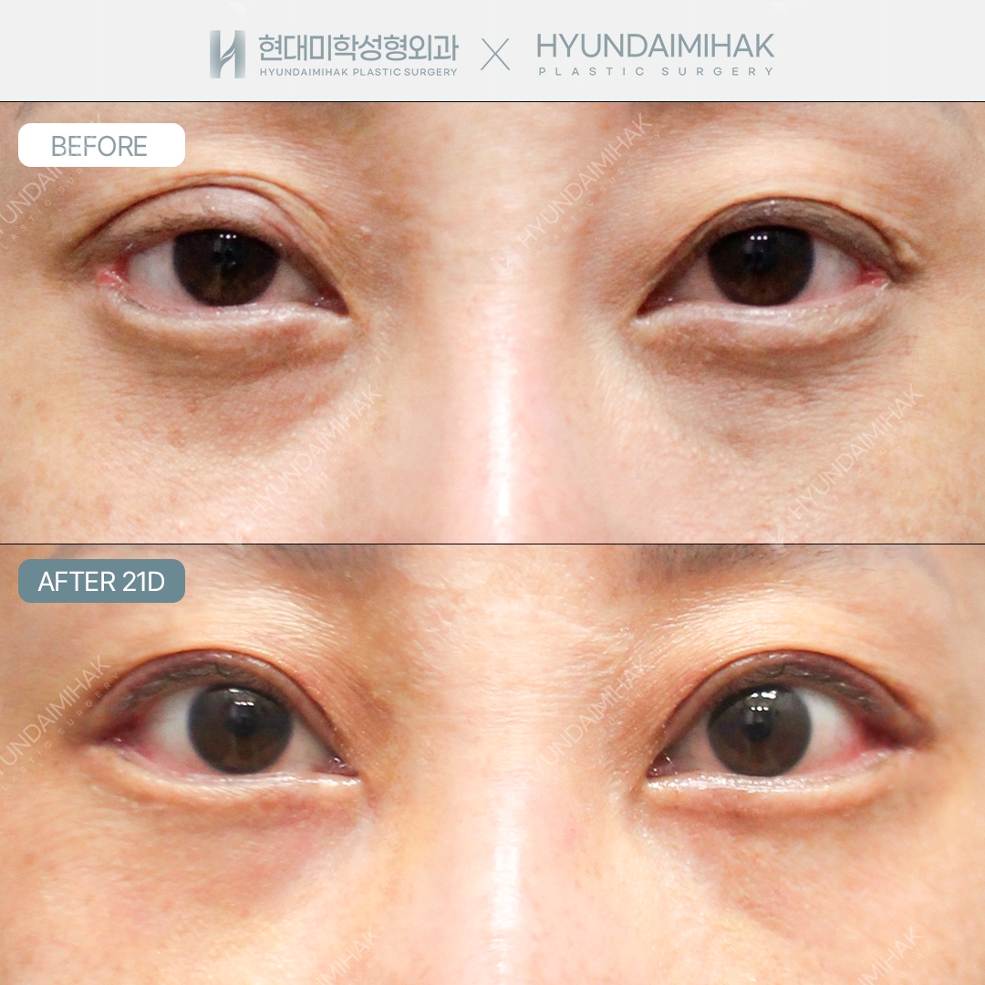 [Eye revision surgery] Incisional revision surgery + eye shape correction + lateral canthoplasty restoration