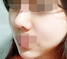 I had contouring surgery, posting my review haha