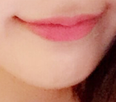 Escaping ugly-lip syndrome
