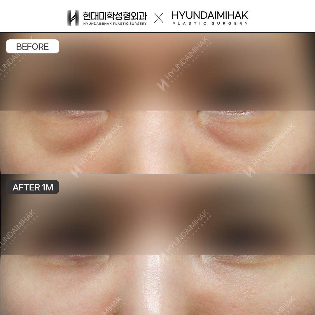 [Middle-aged Eye Surgery] Under-eye fat repositioning