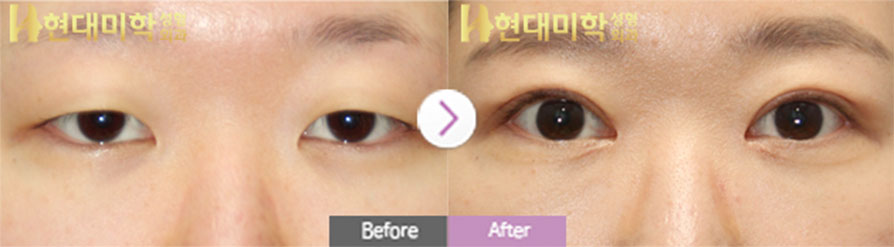 Incisional Eye Surgery, Ptosis Correction, Epicanthoplasty