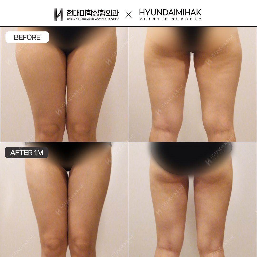 Thigh Liposuction, 1 Month