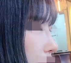 o0o One-month progress after nose surgery!!