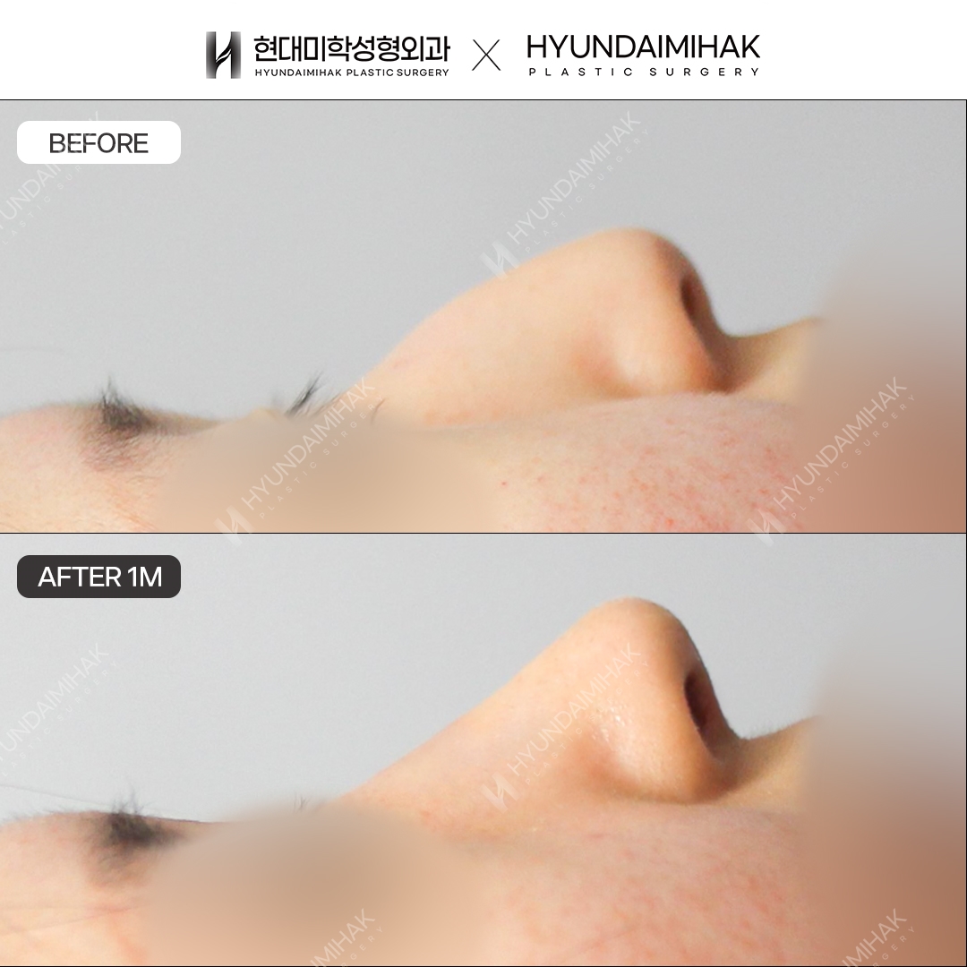 [Hump Nose Surgery] Nasal bridge + nasal tip, 1 month post-op