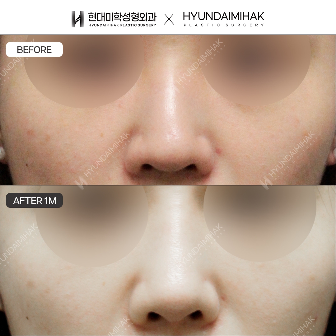 [Hump Nose Surgery] Bridge + Tip, 1 Month
