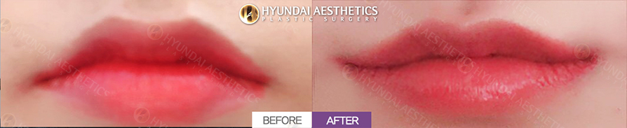Mouth Corner Lift