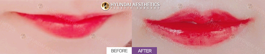 Mouth Corner Lift
