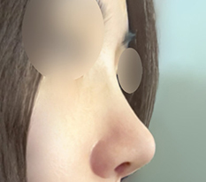 My nose line is already this good even before all the swelling is gone!