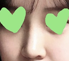 For anyone worrying about rhinoplasty~!!!!!! What more can I say