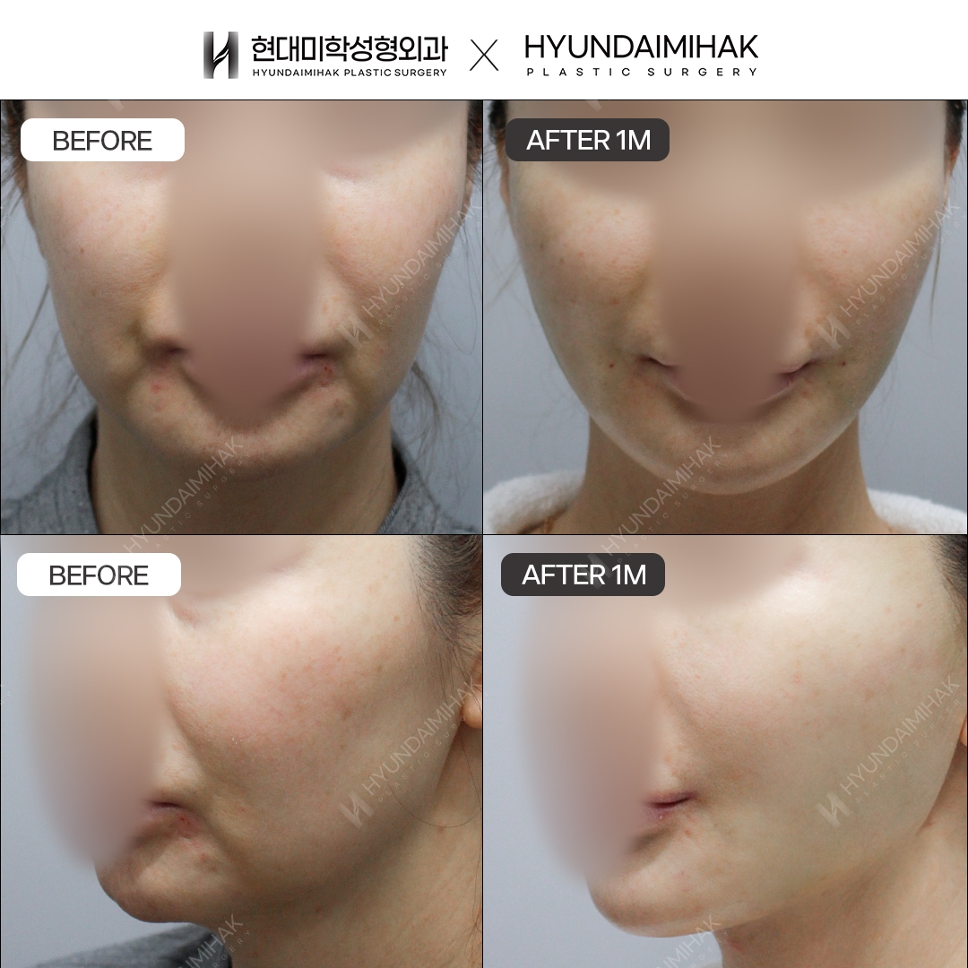 [Anti-Aging Surgery] Thread Lift, 1 Month