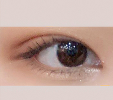 My eyes look more open after lateral and lower canthoplasty