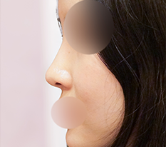 I really love baby-face fat grafting