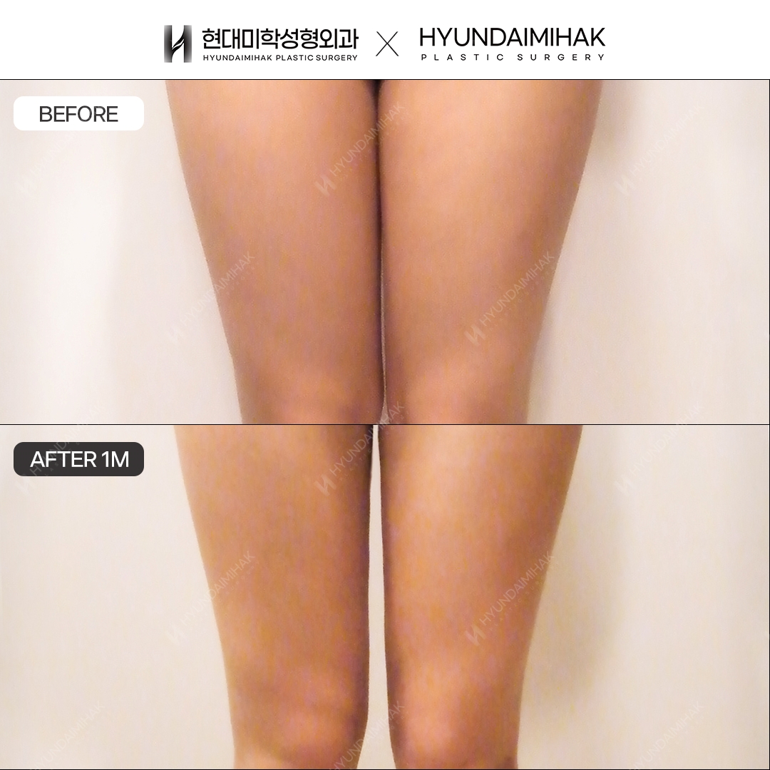 Thigh liposuction, 1 month after surgery
