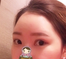Eye correction at Hyundai Aesthetic Surgery!!