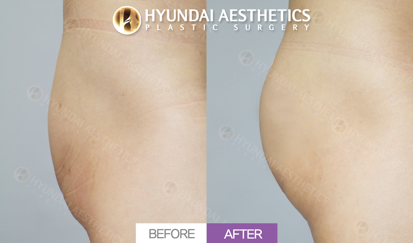 Point Hip-Up Surgery, Buttock Fat Grafting + Liposuction (Back of Thighs & Love Handles) + Elasticum Thread Lifting
