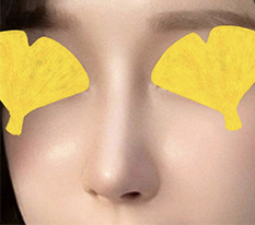 #HyundaiAesthetic #NoseJob #Successful