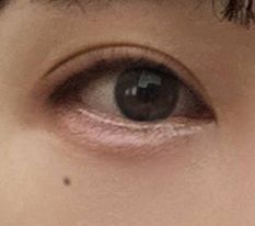 Incisional double eyelid surgery was the answer