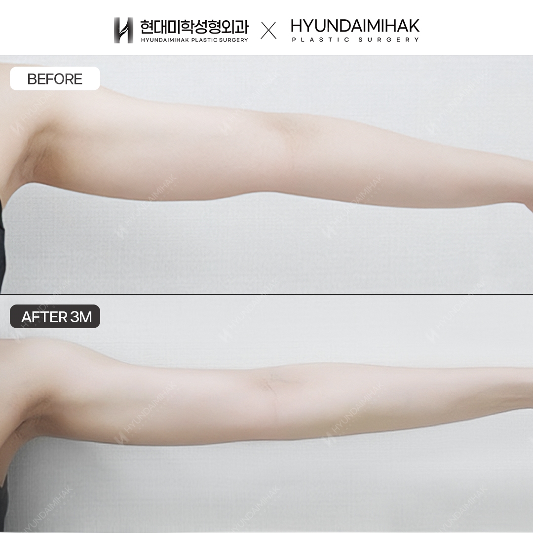 Arm Liposuction, 3 Weeks