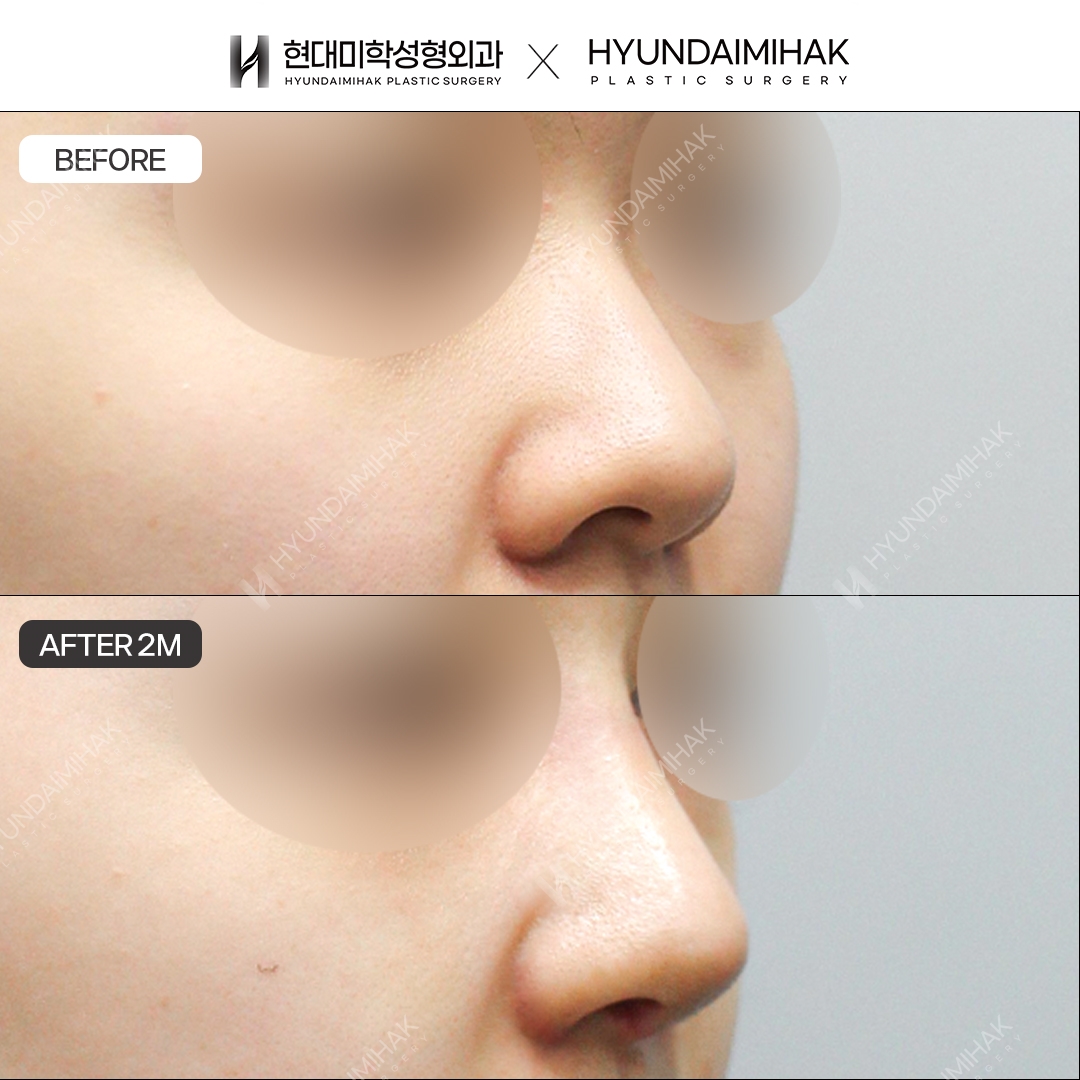 [Bulbous Nose Surgery] Nasal bridge + nasal tip, 2 months post-op