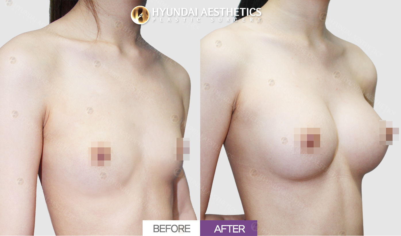 Breast Augmentation (Teardrop Implants)