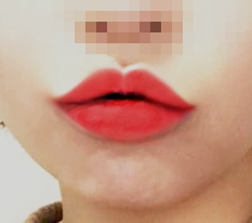 Philtrum reduction + mouth corners
