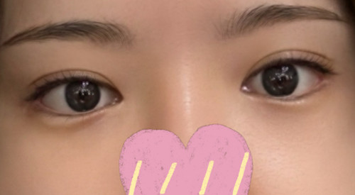 A review of double-eyelid surgery with flawless details!!